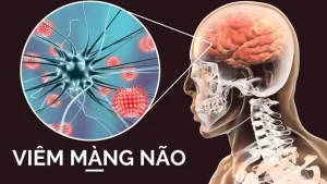 Viêm màng não