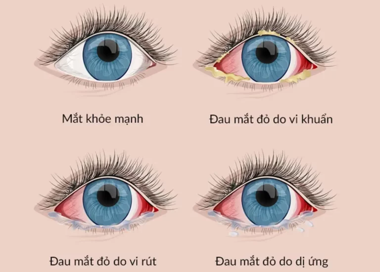 Đau mắt đỏ